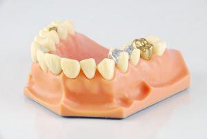 Teeth Model With Filling & Dental Bonding Options