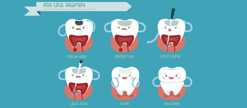 Root Canal Treatment