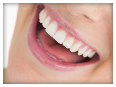 Woman With Porcelain Veneers